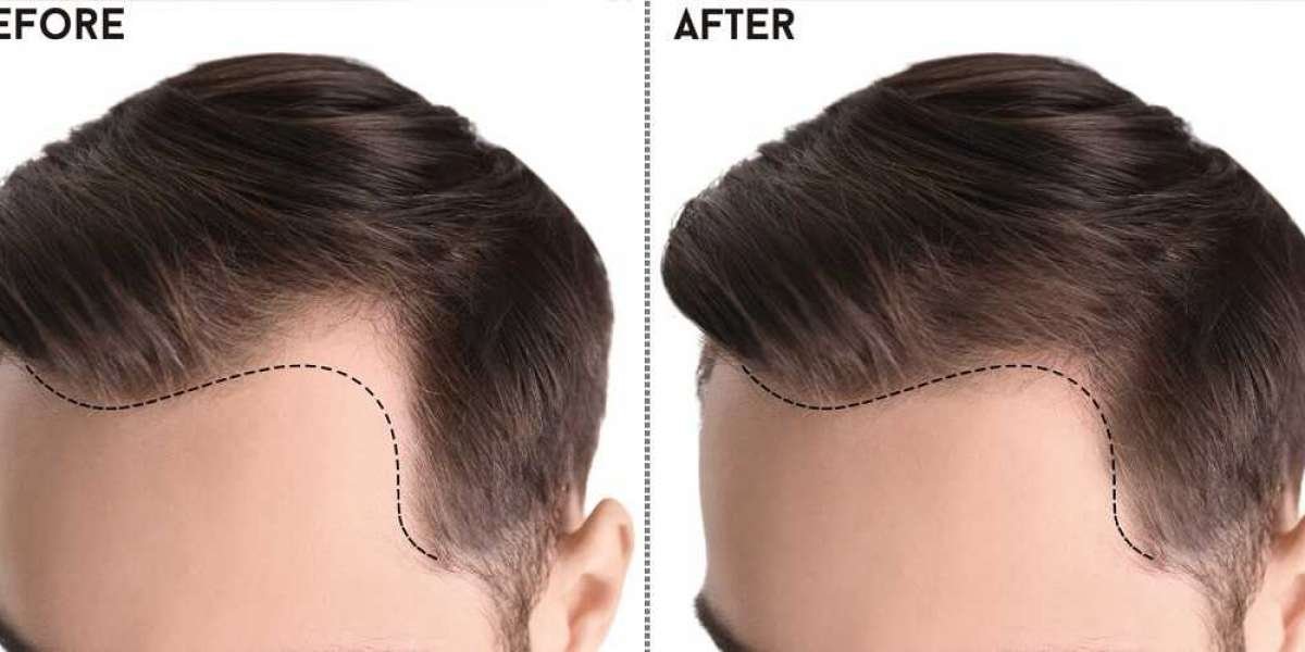 Unlocking Confidence: The Journey of Hair Transplants in Islamabad
