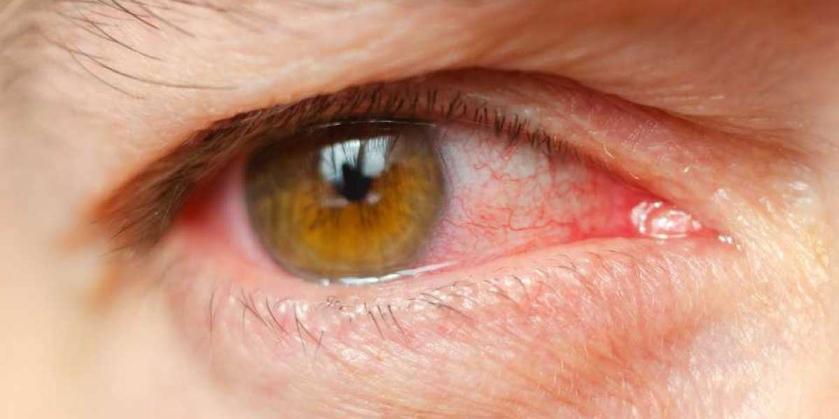 Allergic Conjunctivitis Market Growth, Trends, Absolute Opportunity and Value Chain 2023-2033