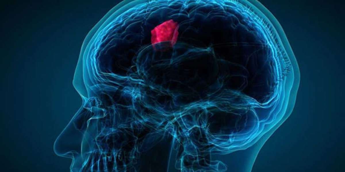 Pediatric Brain Tumor Market Insights: Industry to Accrete with A Whopping CAGR By 2030; Declares MRFR