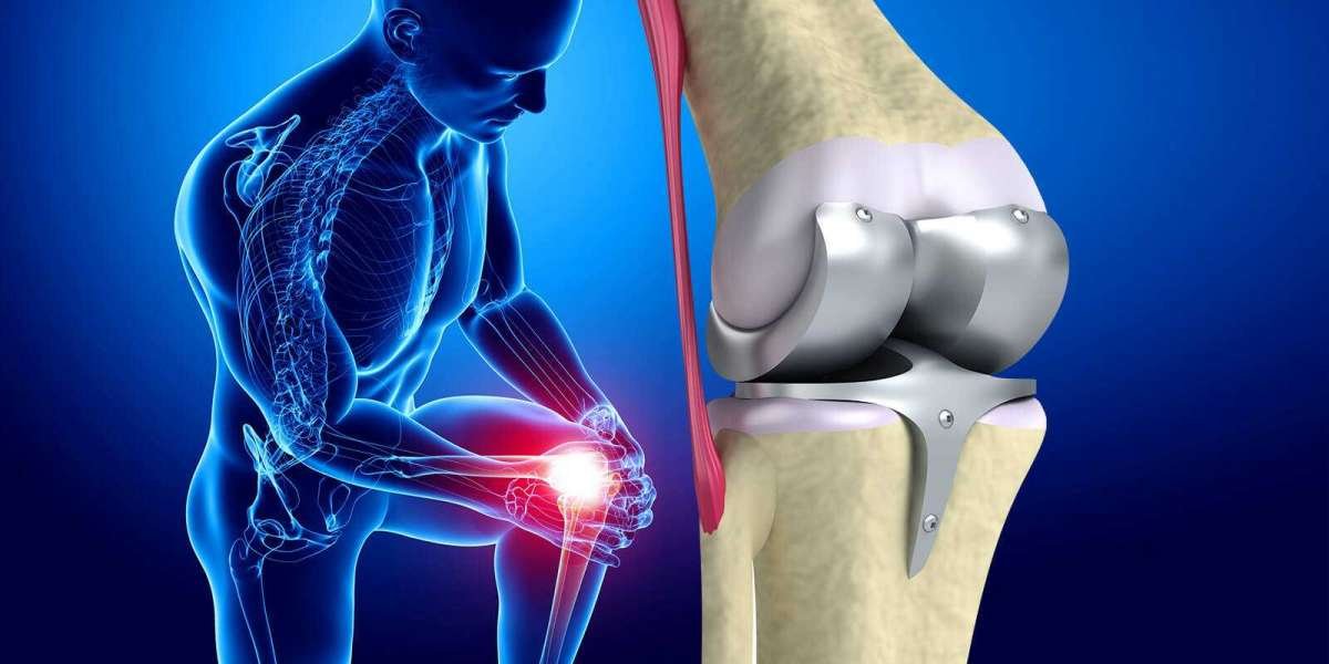 R&D Activities Triggering the Industry Growth; Claims the Knee Replacement Market Insights