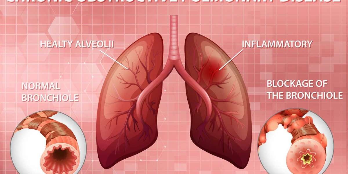 Chronic Obstructive Pulmonary Disease Market Insights Shows Industry Growth Due to Increased User Awareness