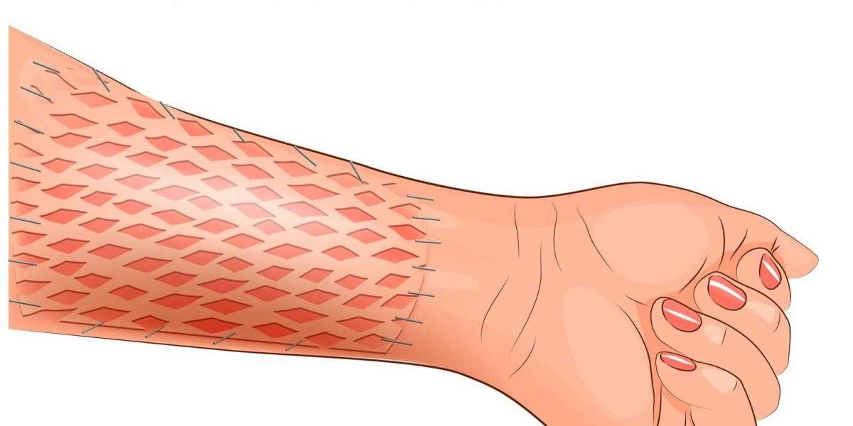 Skin Graft Market Insights Report Projects the Industry to Depict an Impressive CAGR