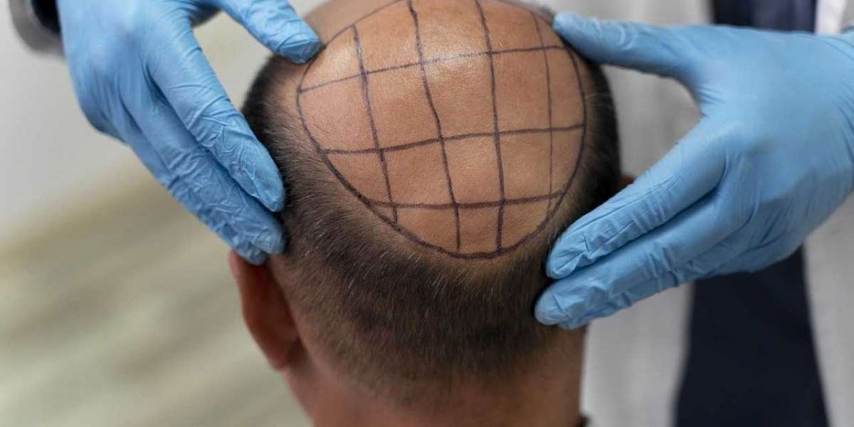 Transformative FUE Hair Transplant: Before & After