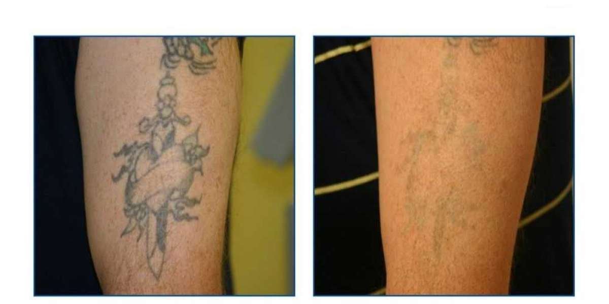 Tattoo Removal Market Size, Industry Growth Report, 2024-2032