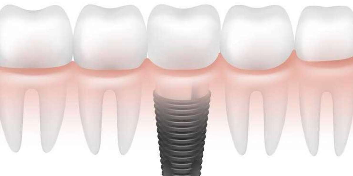 The Ultimate Guide to Professional Dental Implants: Restoring Your Smile with Confidence