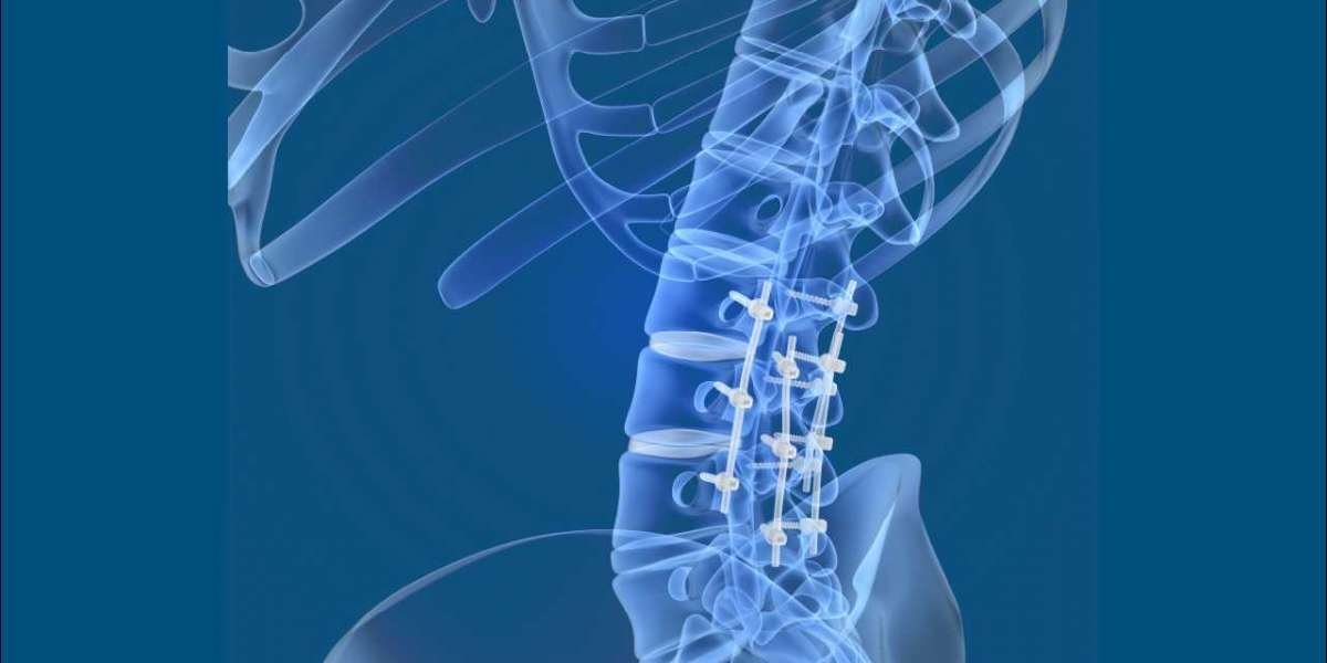 Spine Fixation Market Size, Trends, Scope and Growth Analysis to 2033