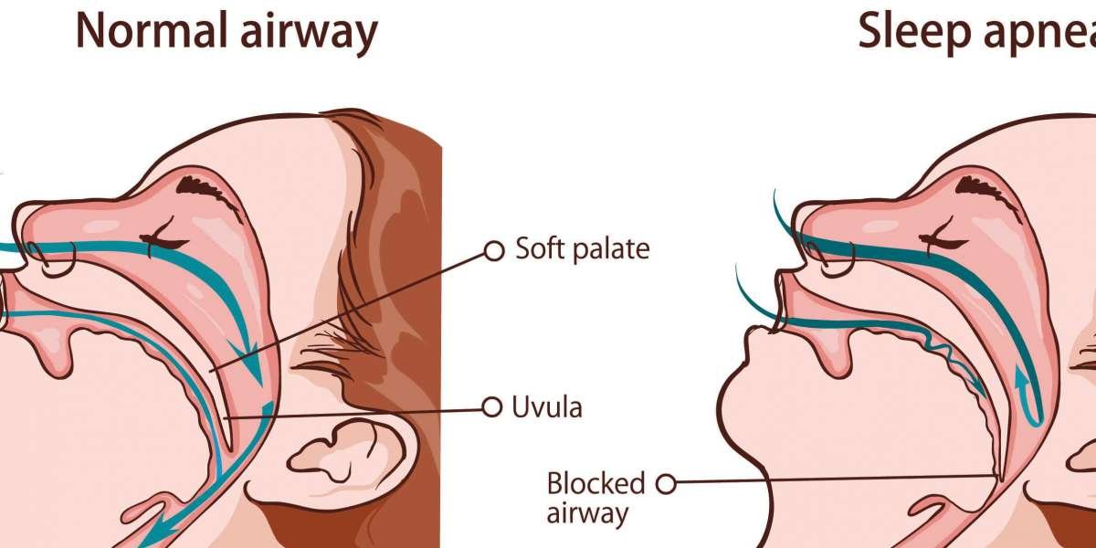 Breathing Easy at Night: Sleep Apnea Devices Offer Solutions for Restful Sleep