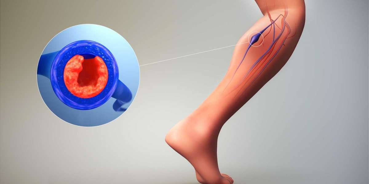 Deep Vein Thrombosis Treatment Market: Growth and Future Outlook (2024)