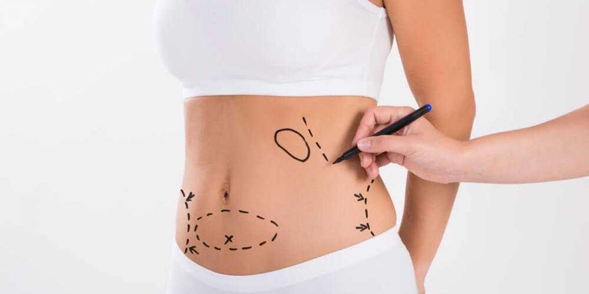 Managing Swelling and Bruising After Liposuction
