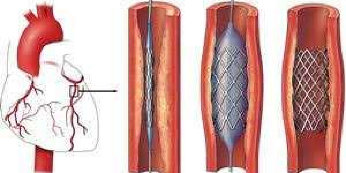 Understanding the Cost of Angioplasty in Chennai