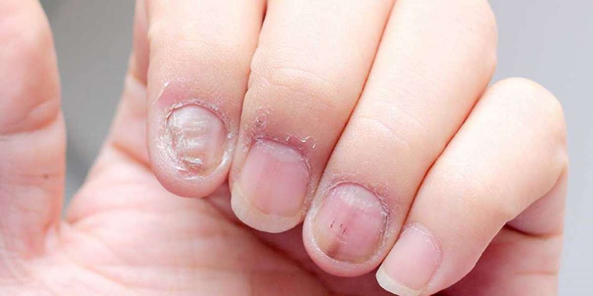 What is treatment fungal nail infections