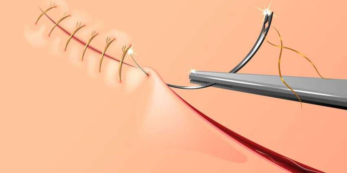 Micro-points, Robotic Compatibility, Biocompatible Coatings: Unveiling the Future of Suture Needles