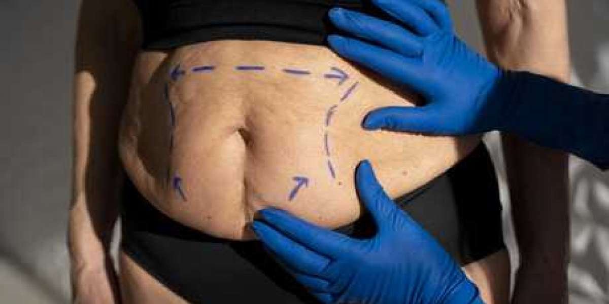 Unlocking Excellence: The Best Surgeon for Tummy Tuck in Ludhiana