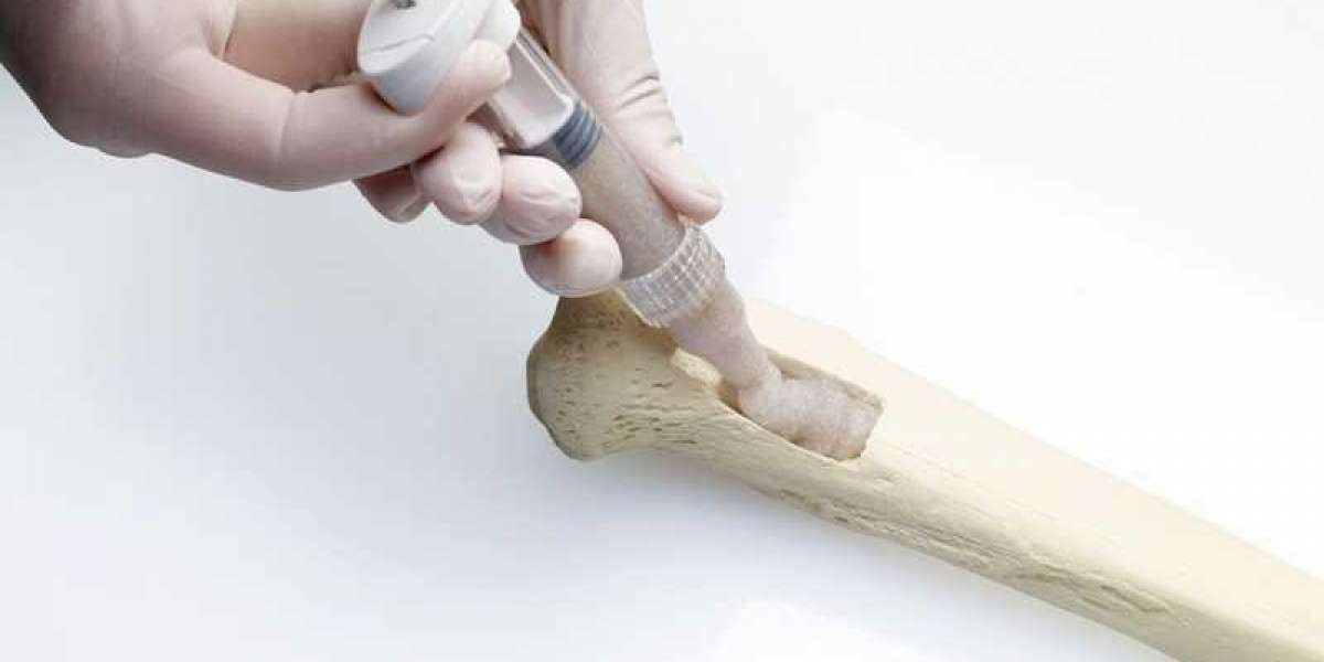 The Future of Bone Healing: How Substitutes are Transforming Surgery