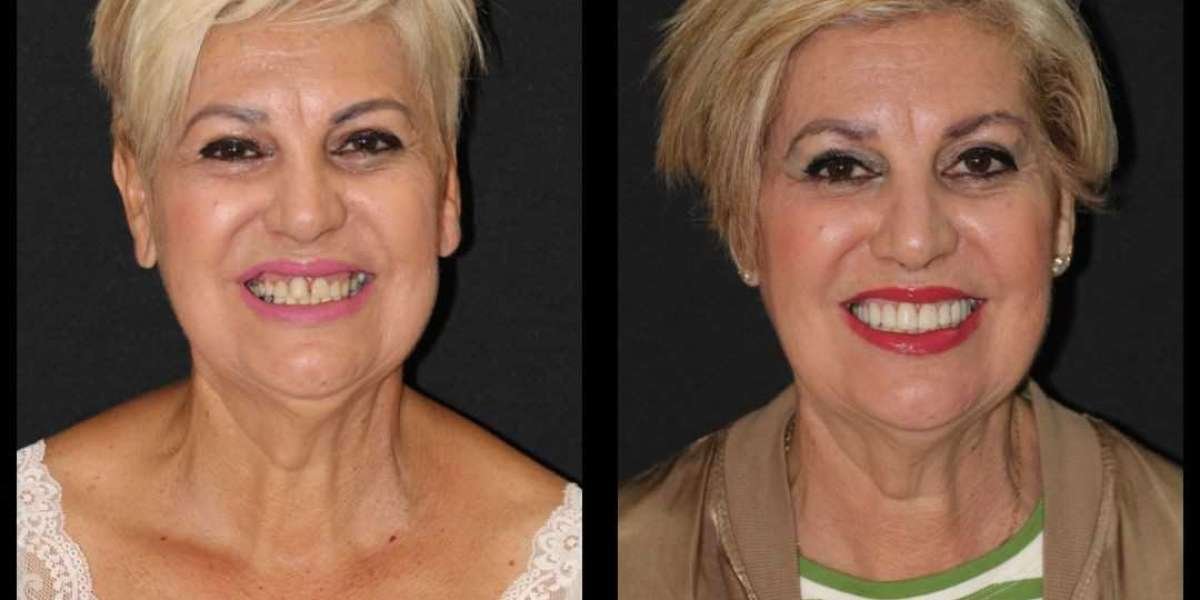 Recupera Tu Sonrisa con Implantes Dentales