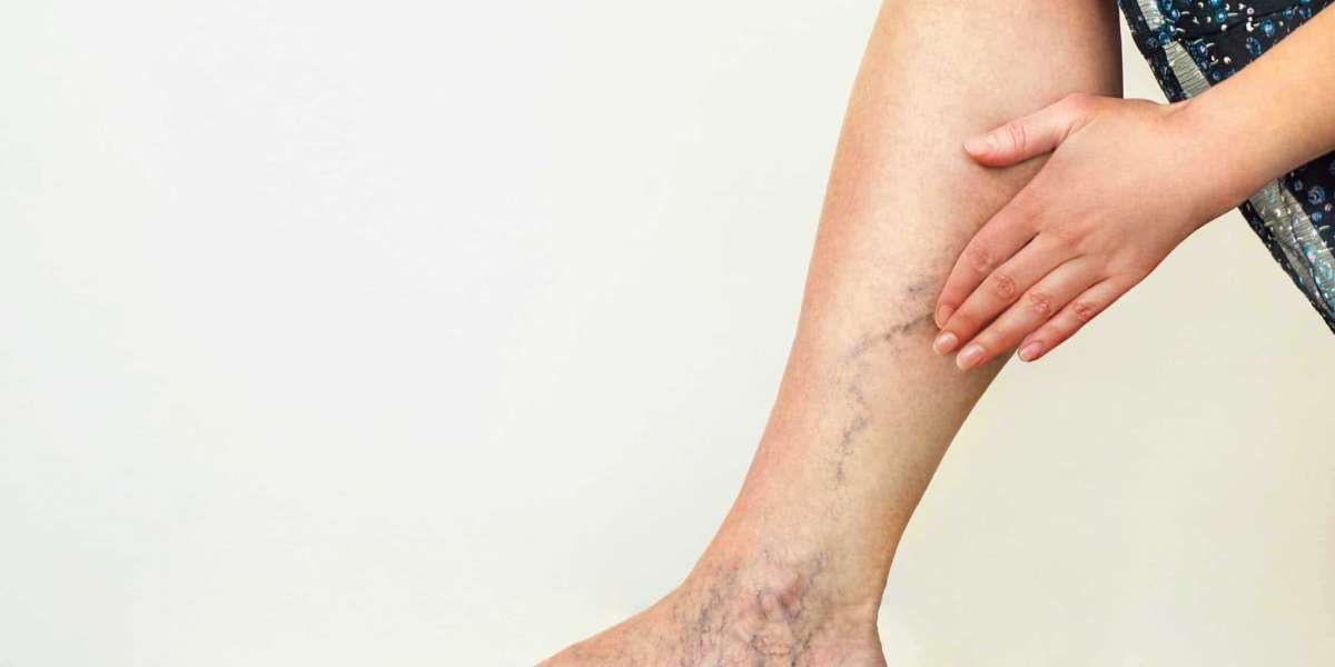 The Hidden Connection Between Varicose Veins and Cancer: What You Need to Know