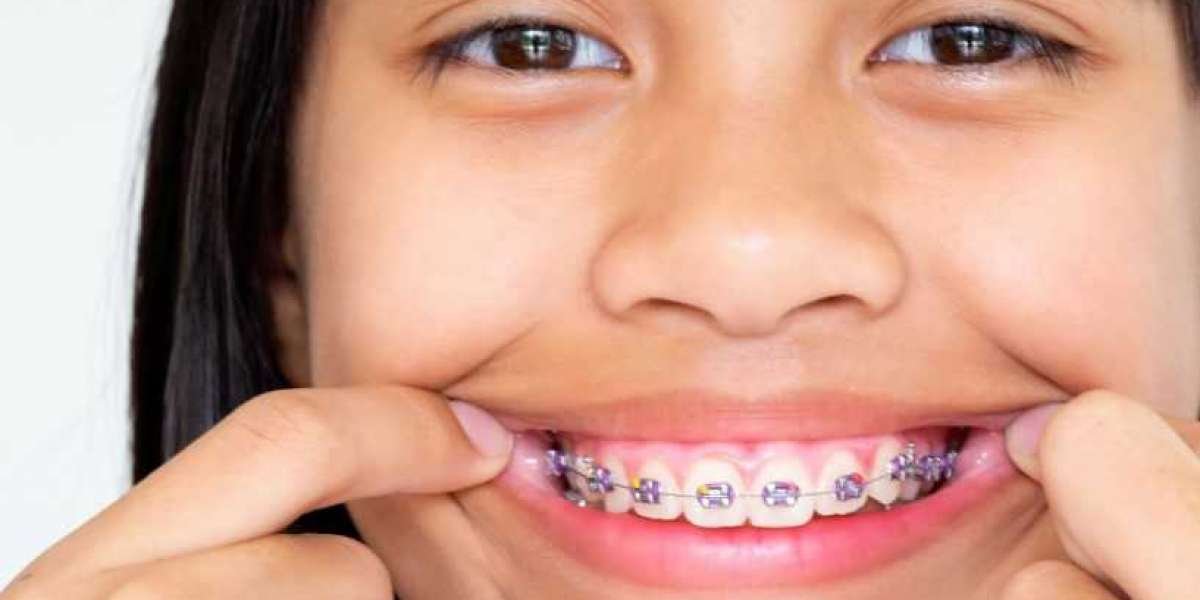 Implantes Dentales Precio: Todo lo que Necesitas Saber para Recuperar tu Sonrisa