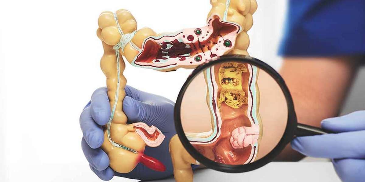 Make Your Health For Best Decision To Choosing Colorectal Surgeon Mumbai